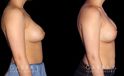 Procedures Depicted:  Breast Augmentation-Remove and Replace Saline & Full Lift