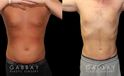 Male liposuction results before and after the procedure, showing the tighter abdomen. Note the significant improvement shown when sitting, showcasing the reduced belly fat from lipo.