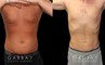 Male liposuction results before and after the procedure, showing the tighter abdomen. Note the significant improvement shown when sitting, showcasing the reduced belly fat from lipo.