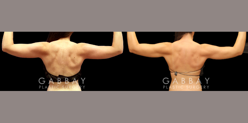 Procedures Depicted:  Liposuction to inner thighs and arms