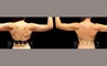 Procedures Depicted:  Liposuction to inner thighs and arms