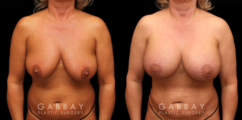 Procedures Depicted:  Breast Aug/Pexy with Liposcution and J-plasma to the Full Abdomen and Upper Back Bra Roll