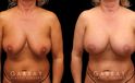 Procedures Depicted:  Breast Aug/Pexy with Liposcution and J-plasma to the Full Abdomen and Upper Back Bra Roll