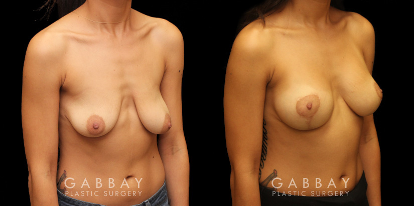 Procedures Depicted:  Augpexy with mesh