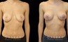 Patient 29 Front View Breast Mastopexy Gabbay Plastic Surgery