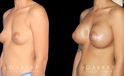 Before-and-after photos for breast augmentation with saline implants. The choice of saline implants allowed for more dramatic increase in breast size while having no visible scars.
