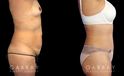 Patient before and after plastic surgery combination procedure involving breast augmentation (silicone implants), tummy tuck, and liposuction of the flanks. The combined results show a slimmer, more youthful profile with an enhanced feminine shape.