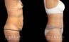 Patient before and after plastic surgery combination procedure involving breast augmentation (silicone implants), tummy tuck, and liposuction of the flanks. The combined results show a slimmer, more youthful profile with an enhanced feminine shape.