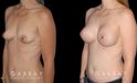 Silicone implants results for female patient in her 30s. Smaller, loose breasts were augmented to a firmer, taut volume with minimal overhang for improved comfort.
