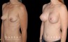 Silicone implants results for female patient in her 30s. Smaller, loose breasts were augmented to a firmer, taut volume with minimal overhang for improved comfort.