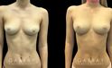 Patient 06 Front View Breast Fat Grafting Gabbay Plastic Surgery