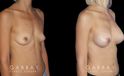 Using silicone implants, the patient saw increased breast volume while maintaining a comfortable, proportionate size. Nipple position and overall breast aesthetic was maintained while increasing size.