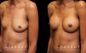 Patient before-and-after photos for breast augmentation with silicone implants. Patient increased cup size while maintaining a natural, balanced look to the breasts.