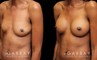 Patient before-and-after photos for breast augmentation with silicone implants. Patient increased cup size while maintaining a natural, balanced look to the breasts.