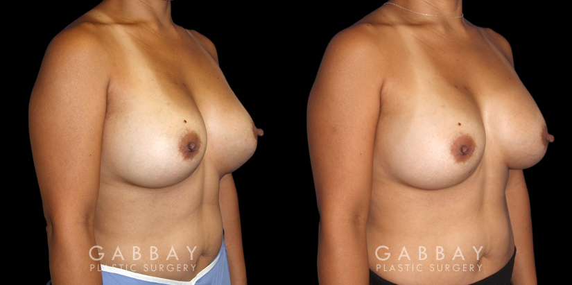 Procedures Depicted:  Breast Revision
