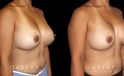 Procedures Depicted:  Breast Revision
