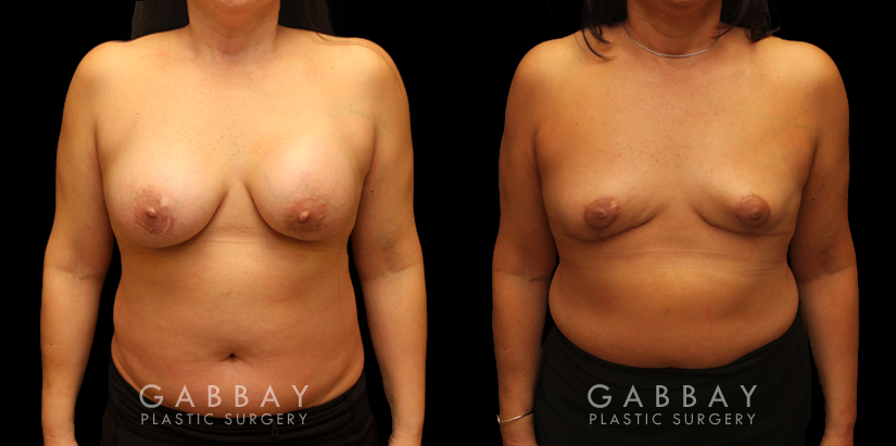 Procedures Depicted:  Auto Augmentation with lift