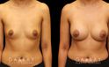 Before and after silicone implants for female patient. Her breast augmentation went smoothly and the recovery was without complications.