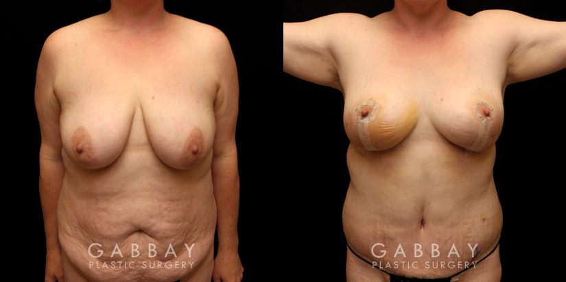 Procedures Depicted:  Tummy Tuck and Breast lift