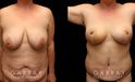 Procedures Depicted:  Tummy Tuck and Breast lift