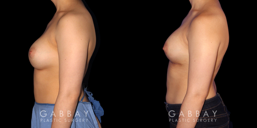 Procedures Depicted:  Breast Augmentation-Remove and Replace Saline & Full Lift
