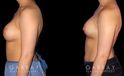 Procedures Depicted:  Breast Augmentation-Remove and Replace Saline & Full Lift