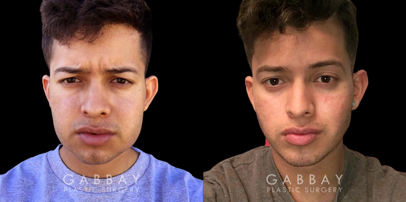 Procedures Depicted:  Buccal Lipidectomy