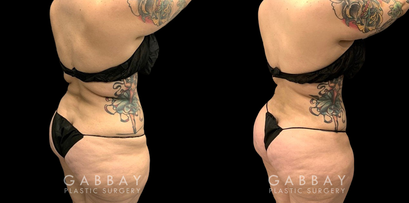 Procedures Depicted:  Abdomen Lipo Female liposuction results for a flatter abdomen. Note how fat reduction was done with her natural figure in mind for results that match her unique features.