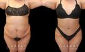 Tummy tuck patient photos from before and after the procedure. On the left, patient shows loose skin and significant banding/rolling of the skin. After the surgery, patient has tightened skin on all angles and note the absence of overhanging skin even when leaning forward.