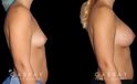 Silicone implants used to increase breast size in female patient in her 30s. Boost ot breast volume resulted in a more feminine contour from each before-and-after photo angle.