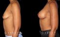 Before-and-after photos for saline implant breast augmentation patient. Her implant choice allowed for more natural shape and slope to the breasts, most notable in the profile view.