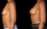 Before-and-after photos for saline implant breast augmentation patient. Her implant choice allowed for more natural shape and slope to the breasts, most notable in the profile view.