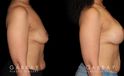Patient with combined breast lift and breast augmentation using saline implants. Patient fully recovered from the combination procedure with excellent results.
