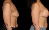 Patient with combined breast lift and breast augmentation using saline implants. Patient fully recovered from the combination procedure with excellent results.