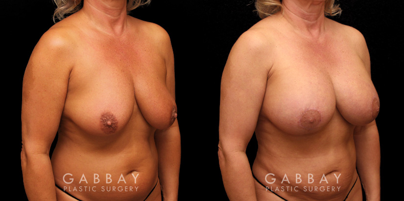 Procedures Depicted:  Breast Aug/Pexy with Liposcution and J-plasma to the Full Abdomen and Upper Back Bra Roll