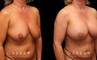 Procedures Depicted:  Breast Aug/Pexy with Liposcution and J-plasma to the Full Abdomen and Upper Back Bra Roll