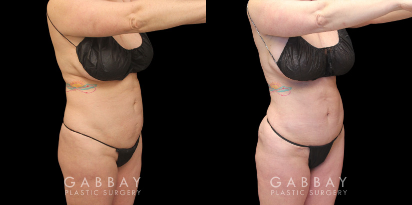 Patient 02 Front View Mini Tummy Tuck Gabbay Plastic Surgery