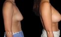 Female patient in her 20s before-and-after revision breast augmentation, including implant removal and replacement with additional breast lift to improve breast position.
