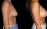 Female patient in her 20s before-and-after revision breast augmentation, including implant removal and replacement with additional breast lift to improve breast position.