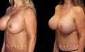 Procedures Depicted:  Abdominoplasty