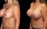 Procedures Depicted:  Abdominoplasty