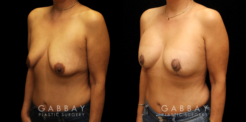 Procedures Depicted:  Breast Aug/Pexy
