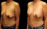 Procedures Depicted:  Breast Aug/Pexy