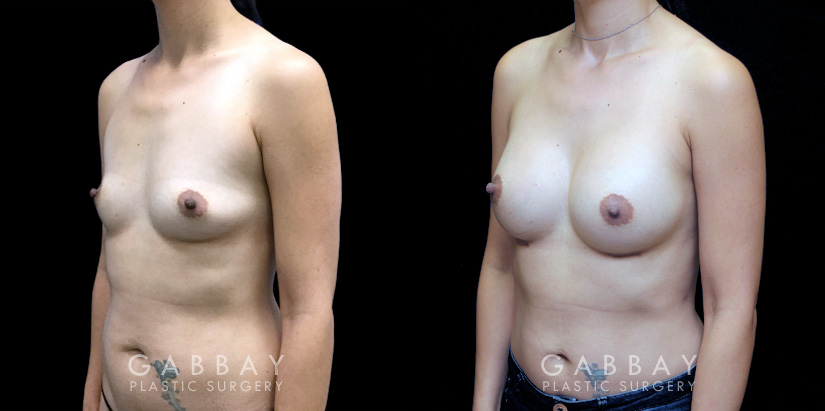 Procedures Depicted:  Breast Augmentation – Silicone