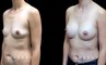 Procedures Depicted:  Breast Augmentation – Silicone