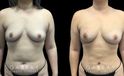 Patient 05 Front View Breast Fat Grafting Gabbay Plastic Surgery