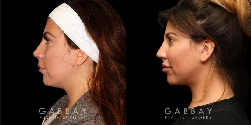 Procedures Depicted:  Buccal Fat Pad Removal