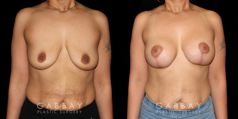 Procedures Depicted:  Breast Augmentation – Silicone & Lift