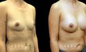 Breast augmentation results for patient in her 40s. Volume increase is mild but retains a natural shape to the breasts with retained symmetry.