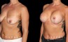 Procedures Depicted:  Wise Mastopexy with Silicone Breast Implants